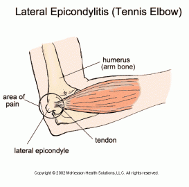 [Hearth.com] Tennis Elbow... from splitting wood.