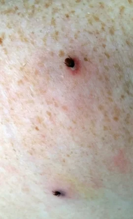 [Hearth.com] Tick bites and Lyme disease