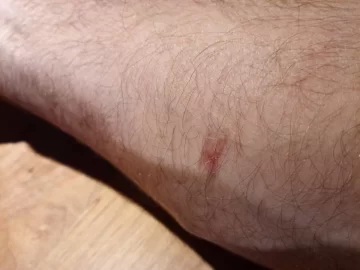 [Hearth.com] Anyone else branded by their stove