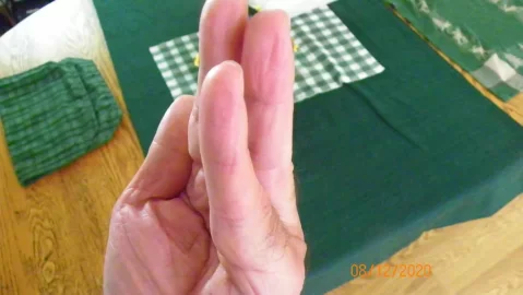 [Hearth.com] Dupuytren's Contracture