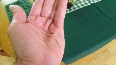 [Hearth.com] Dupuytren's Contracture