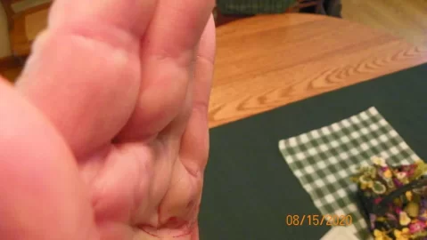 [Hearth.com] Dupuytren's Contracture