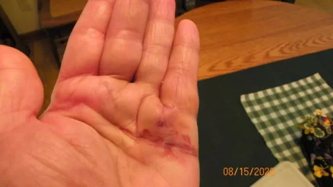 [Hearth.com] Dupuytren's Contracture